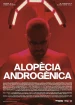 Alopècia androgènica