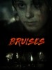 Bruises