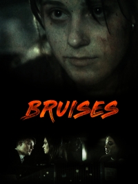 Bruises