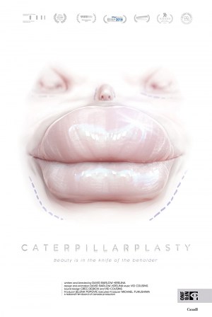 Caterpillarplasty