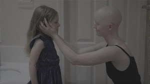 Alopecia